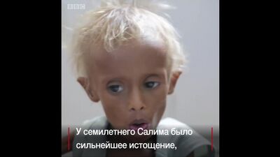 От голода в Йемене страдают миллионы детей